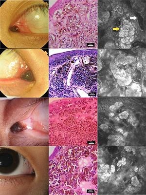 Morphological characterization of nevi on the caruncle conjunctiva under in vivo confocal microscopy